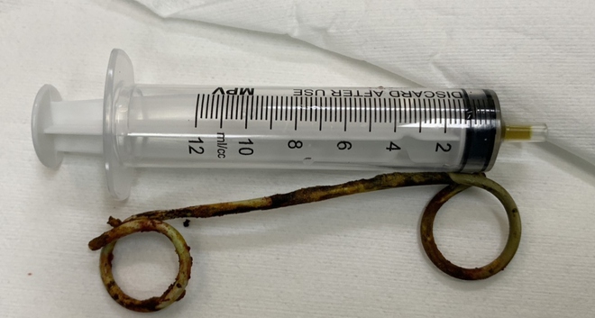 Phẫu thuật lấy th&agrave;nh c&ocirc;ng stent bị bỏ qu&ecirc;n trong ống mật của cụ b&agrave; 77 tuổi suốt 6 năm - Ảnh 1.