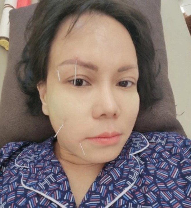 Vài sao Việt không may bị liệt nửa mặt, có người đứng trước nguy cơ đột quỵ - Ảnh 3.