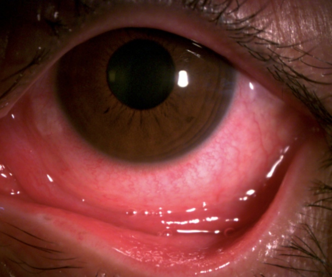 Đau mắt đỏ có thể biến chứng nguy hiểm, mất thị lực vĩnh viễn - Ảnh 1.