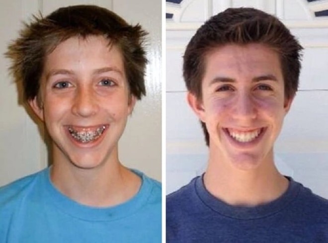 20 bức ảnh chứng minh niềng răng thay đổi nụ cười của bạn ra sao - Ảnh 20.