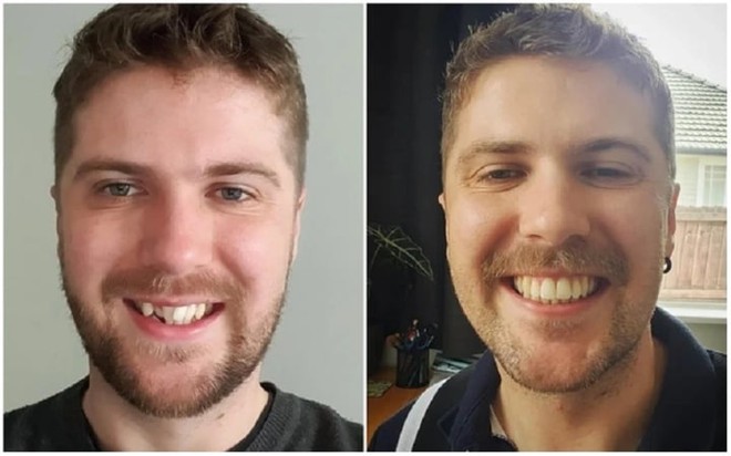 20 bức ảnh chứng minh niềng răng thay đổi nụ cười của bạn ra sao - Ảnh 4.