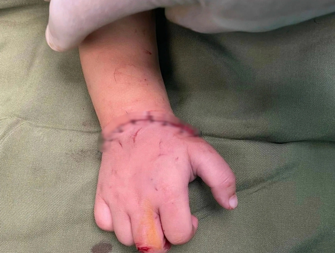 Bé gần 18 tháng tuổi bị máy cắt đá của gia đình cắt đứt lìa bàn tay - Ảnh 2.