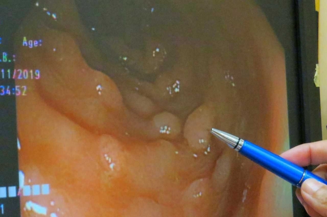 Polyp ở 3 vùng dễ dẫn đến ung thư, 5 thói quen tốt cần làm để tránh - Ảnh 1.