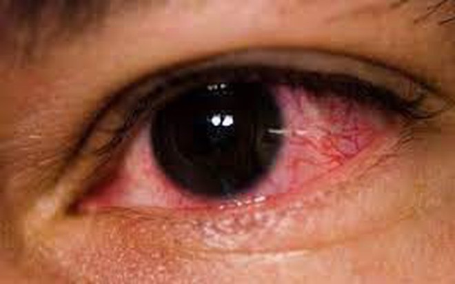 Sở Y tế TP. Hồ Chí Minh: Đã xác định được tác nhân gây bệnh đau mắt đỏ - Ảnh 1.