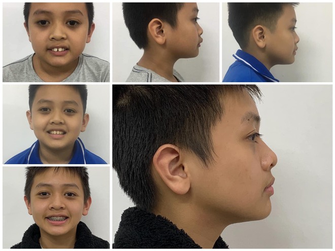 BS khoa Răng Hàm Mặt chỉ ra những trẻ nên niềng răng và vì sao cần niềng răng sớm - Ảnh 2.