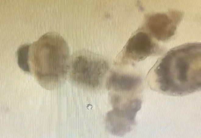 Người đàn ông nhiễm ấu trùng sán dây chó ký sinh tại phổi - Ảnh 3.
