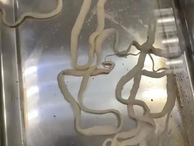 Sinh vật d&agrave;i 4 m&eacute;t bị &ldquo;trục xuất&rdquo; khỏi cơ thể c&ocirc; g&aacute;i trẻ, b&aacute;c sĩ: thịt n&agrave;y ngon nhưng cẩn thận khi ăn - Ảnh 2.