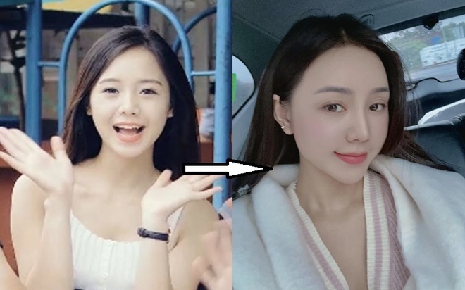 Quỳnh Kool: Từng thừa nhận tiêm filler vào 6 năm trước, giảm cân thành công nhờ tập bộ môn đốt calo tại nhà - Ảnh 4. Quỳnh Kool: Từng thừa nhận tiêm filler vào 6 năm trước, giảm cân thành công nhờ tập bộ môn đốt calo tại nhà - Ảnh 4.