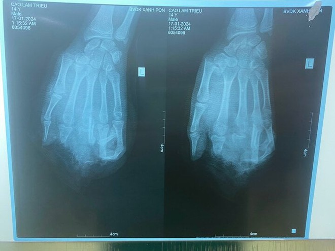 Nổ b&igrave;nh gas mini khi ăn lẩu, thiếu ni&ecirc;n 15 tuổi dập n&aacute;t tay - Ảnh 1.