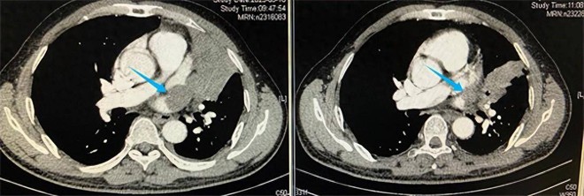 Người đàn ông ho liên tục tưởng cảm lạnh hóa ra bị ung thư phổi, một phần tim bị ăn mất, đâu là đối tượng nên đề phòng? - Ảnh 1.