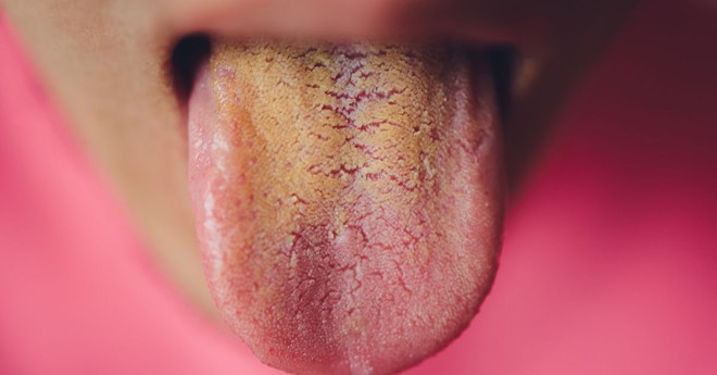 5 điều lưỡi có thể tiết lộ về sức khỏe - từ ung thư đến nguy cơ đột quỵ cũng có thể hiện ra - Ảnh 1.