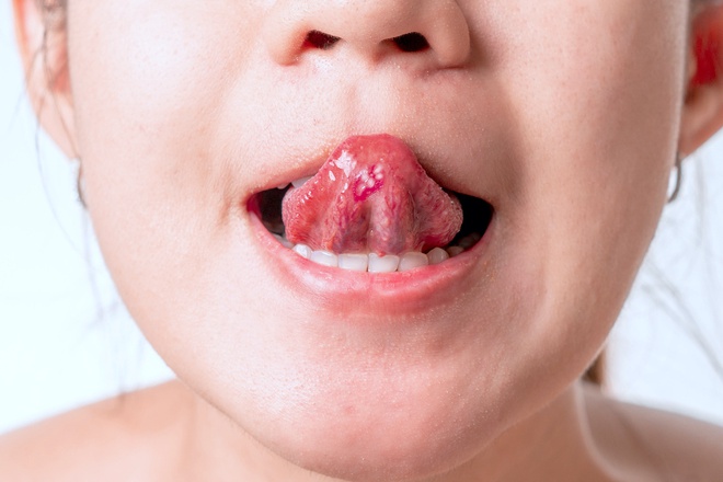 5 điều lưỡi có thể tiết lộ về sức khỏe - từ ung thư đến nguy cơ đột quỵ cũng có thể hiện ra - Ảnh 2.