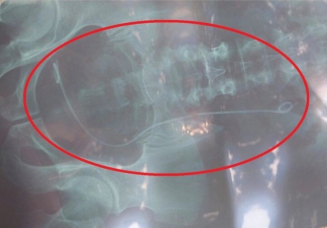 Nhầm kết quả X-quang, bệnh nhân ở Lâm Đồng bị mổ oan, Bộ Y tế chỉ đạo khẩn - Ảnh 1.