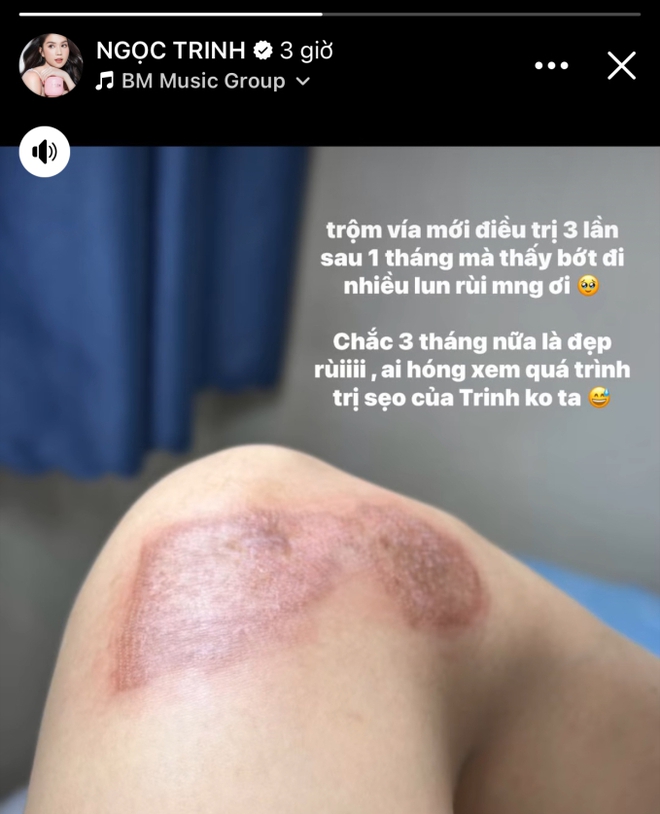 Sau 1 tháng điều trị, Ngọc Trinh tiết lộ hình ảnh vết thương do tai nạn khi diễn xiếc trên mô tô để lại - Ảnh 2.