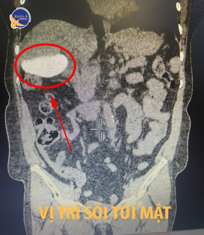 Cho&aacute;ng với số lượng vi&ecirc;n sỏi nhiều kh&ocirc;ng đếm xuể khi cắt t&uacute;i mật cho người phụ nữ ở Vĩnh Long - Ảnh 1.