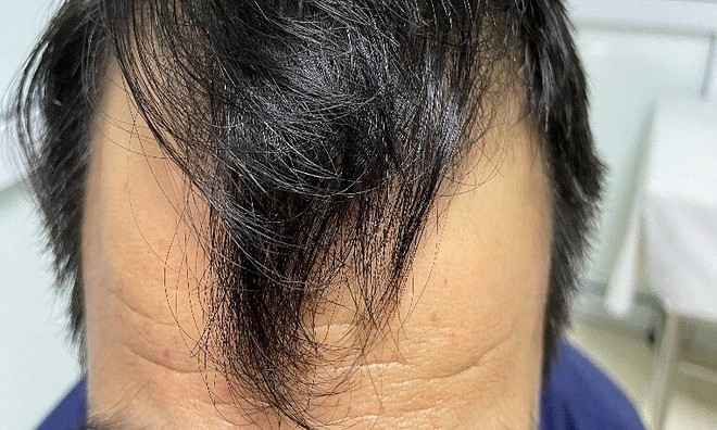 Nam thanh niên 31 tuổi nhập viện vì rụng tóc, tiêu chảy, phát hiện nguyên nhân do ăn thiếu 1 thứ mỗi ngày - Ảnh 2.