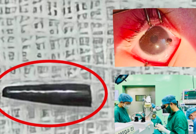Ruột bút chì xuyên thủng nhãn cầu mắt của bé trai 9 tháng tuổi ở Nghệ An - Ảnh 1.