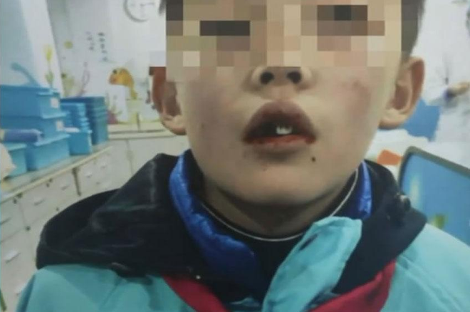 Nam sinh ngã rụng 5 chiếc răng, cốc sữa tươi của giáo viên trở thành vật cứu mạng - Ảnh 1.