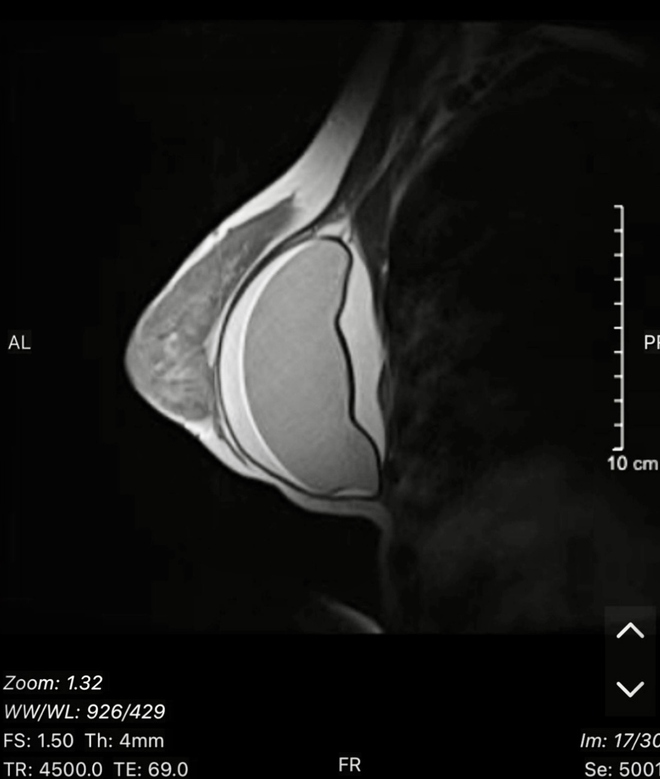 Nâng ngực một thời gian, bị vỡ túi ngực mà không hề hay biết - Ảnh 1.