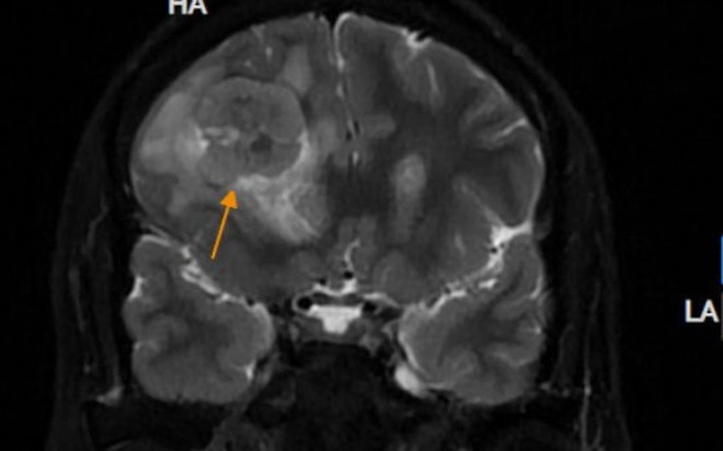 Đau nhức âm ỉ vùng trán, bất ngờ phát hiện khối u não nguy hiểm - Ảnh 1.