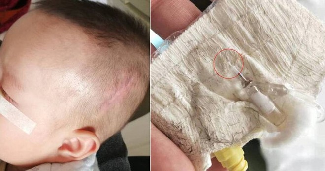 Y tá quên ống luồn kim trong đầu em bé, 5 năm sau nó trôi xuống cổ - Ảnh 1.