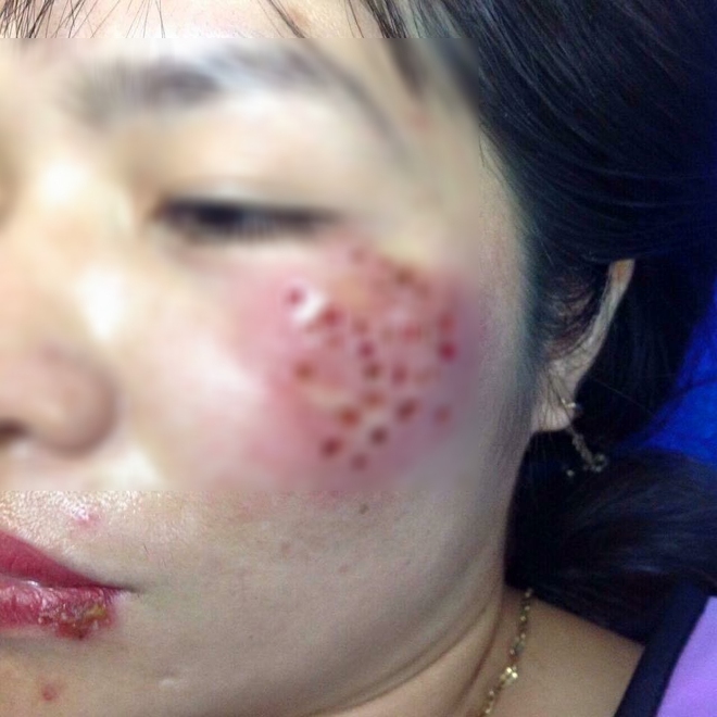 Chữa nám tại spa, người phụ nữ U40 nhận lại gương mặt rỗ như tổ ong, dịch chảy không ngừng - Ảnh 1.