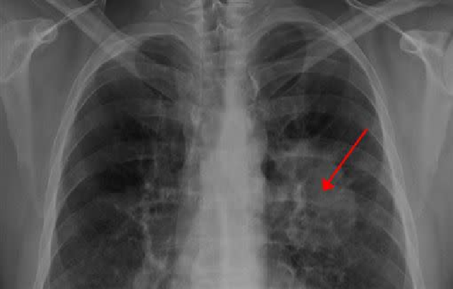 Người phụ nữ 37 tuổi qua đời sau 2 tuần phát hiện ung thư phổi, bác sĩ cảnh báo 1 dấu hiệu hầu hết mọi người đều bỏ qua - Ảnh 1.