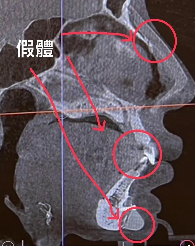 Sốc: Sao nữ nghiện “dao kéo” tung ảnh chụp X-quang khuôn mặt với dị vật 3cm tồn tại trong cằm suốt 8 năm - Ảnh 2.