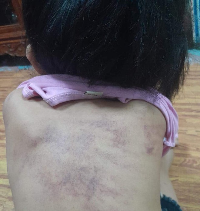B&eacute; 5 tuổi t&iacute;m bầm lưng: Ph&acirc;n c&ocirc;ng 3 gi&aacute;o vi&ecirc;n phụ tr&aacute;ch lớp l&agrave;m nhiệm vụ kh&aacute;c - Ảnh 1.