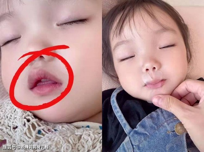 Thấy con gái 8 tuổi ngủ mở miệng, mẹ dùng băng keo dán khiến bé suýt ngạt thở, bác sĩ chỉ ra sai lầm - Ảnh 1.