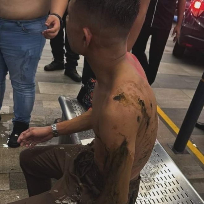 Đã bắt được nghi phạm tạt axit cầu thủ Malaysia, nhìn hình ảnh da bong tróc khiến ai cũng rùng mình - Ảnh 1.