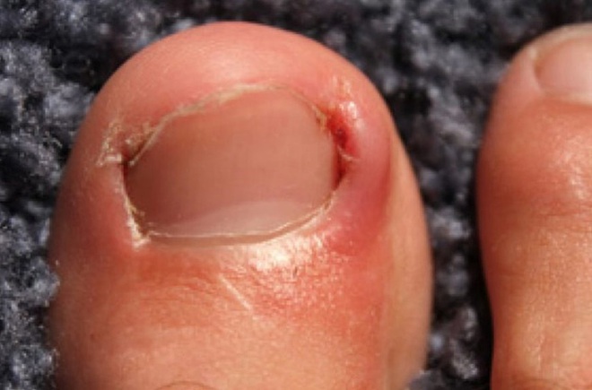 Xem nhẹ 1 khó chịu thường gặp ở móng tay, người đàn ông phải cắt cụt ngón trỏ vì ung thư - Ảnh 2.