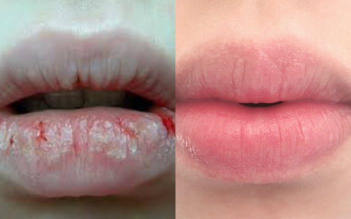 Áp dụng ngay 6 chiêu này: môi khô nứt nẻ đến mấy cũng thành căng mềm