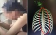 Làm theo mẹo giảm cân gây sốt MXH Trung Quốc, cô gái vô tình nuốt chửng ống nhựa dài 30cm