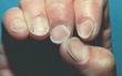 Người có gan xấu sẽ hiển thị rõ 4 vấn đề trên đôi bàn tay, mắc trúng 2 cái thì nên đi khám ngay