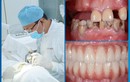 Tiêu chân răng là gì? Phân loại và cách điều trị
