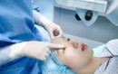 Mổ cận rồi có tái cận lại không và làm cách nào để "phòng bệnh hơn chữa bệnh"?