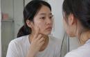 Mụn không chỉ là câu chuyện tuổi dậy thì
