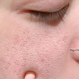 Chuyên gia chỉ ra: Có tới 4 loại lỗ chân lông to và cách khắc phục hiệu quả nhất