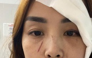 Một phụ nữ ở Nha Trang tố cáo "bị người không quen biết rạch mặt"
