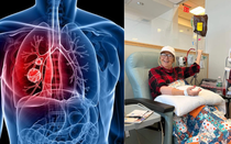 Mỹ phê duyệt thuốc điều trị ung thư phổi giá gần 20 tỷ đồng