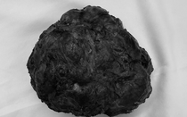 Cô gái trẻ 26 tuổi vòng một to bất thường, bác sĩ phát hiện bí mật bên trong