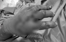Người đàn ông đến bệnh viện với 2 ngón tay đứt lìa được ướp đá