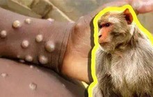 Chuyên gia WHO: Bệnh đậu mùa khỉ có thể đã bùng phát nhờ những cuộc tình 1 đêm tại 2 "tiệc quẩy" ở Châu Âu