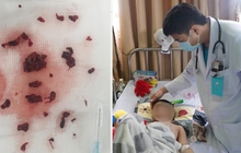 Bé trai 4 tuổi bị đột quỵ sau khi mắc COVID-19