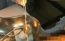 Phát hiện con giun dài 10cm trong mắt người phụ nữ