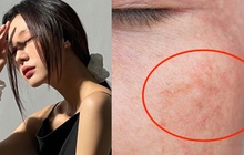 Hóa ra đây mới là lý do khiến da nhanh bị nám, tàn nhang