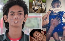 Bị sói tấn công từ khi còn nhỏ, chàng trai 18 tuổi bị dân làng xa lánh, gọi là "cậu bé ma" vì ngoại hình biến dạng khiến nhiều người xót xa