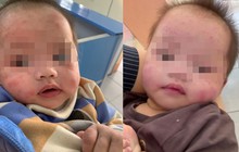 Bé gái 7 tháng tuổi bị bỏ rơi ven đường, gương mặt chi chít vết muỗi đốt