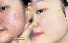 Gái xinh thu về 5 triệu view trên TikTok nhờ hành trình 1 tháng trị mụn với nhiều sản phẩm 'êm ví', có món chưa tới 80K mà thành quả vẫn mê
